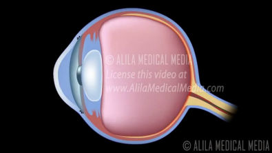 Desenvolvimento_de_Glaucoma,_Ângulo_Aberto_vs_Ângulo_Fechado._Alila_Medical_Medi