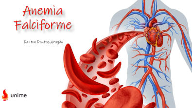 Anemia Falciforme - Resumo