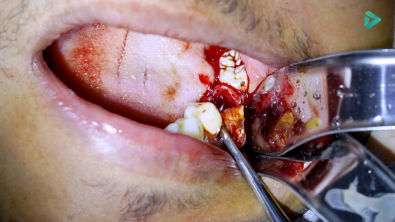 Exodontia de molar inferior com amplamente destruido Passo a passo narrado pelo Dr Filipe Jaeger