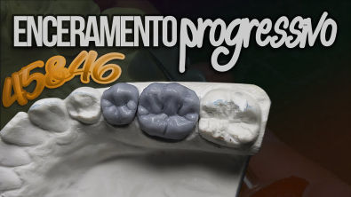 Anatomia e Escultura Dental Enceramento Diagnóstico - 2 Pré-Molar e 1 Molar Inferior (45 e 46)