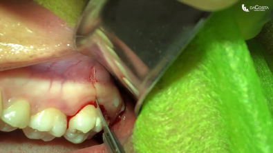 Exodontia de terceiro molar superior Upper wisdom tooth extraction