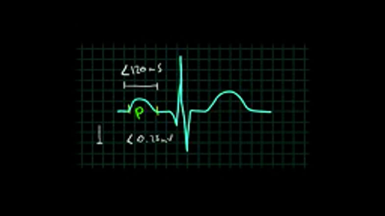 Vídeo-EKG Ondas, intervalos y segmentos 2