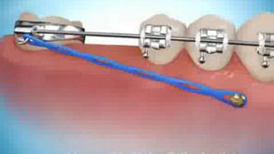 Protrusão de dentes posteriores utilizando mini-implante