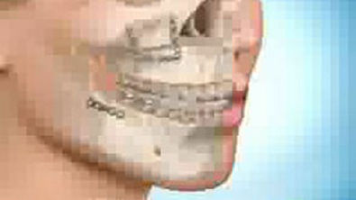Correção Classe III - Cirurgia Ortognática e Ortodontia