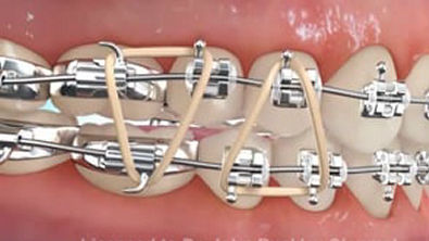 Elastics (delta first molar open bite).wmv orthodontic elastics
