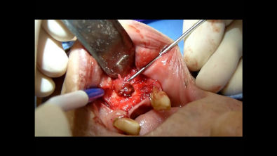 Remoção de Cisto Odontogênico Inflamatório (Cisto Residual)