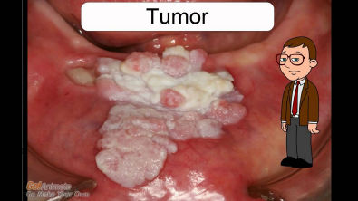 Lesões Fundamentais da Mucosa Bucal.mp4