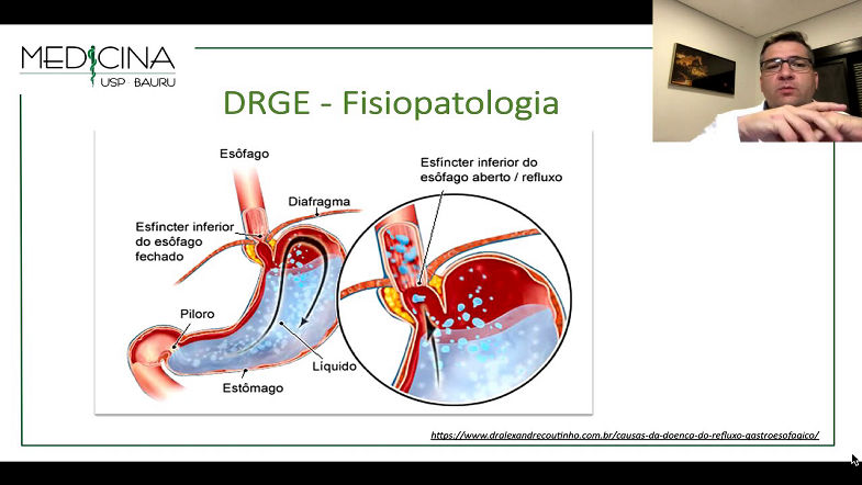 DRGE. Doença do Refluxo Gastroesofágico. MÓDULO 14.