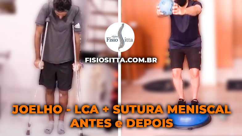 JOELHO LIGAMENTO CRUZADO ANTERIOR REPARO MENISCAL ANTES e DEPOIS Fisioterapia Dr. Robson Sitta