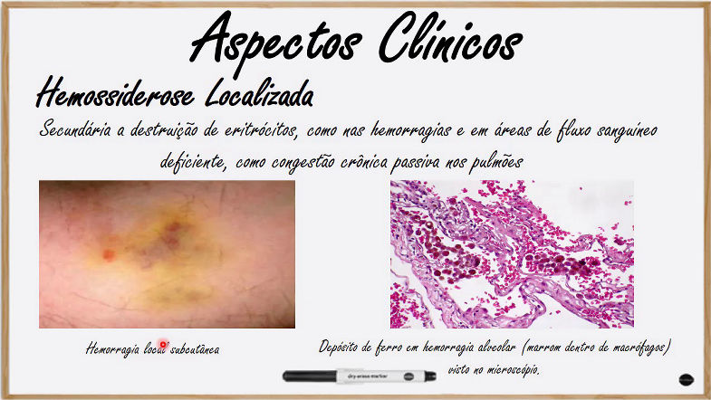 Patologia Geral - Pigmentação - Hemossiderina