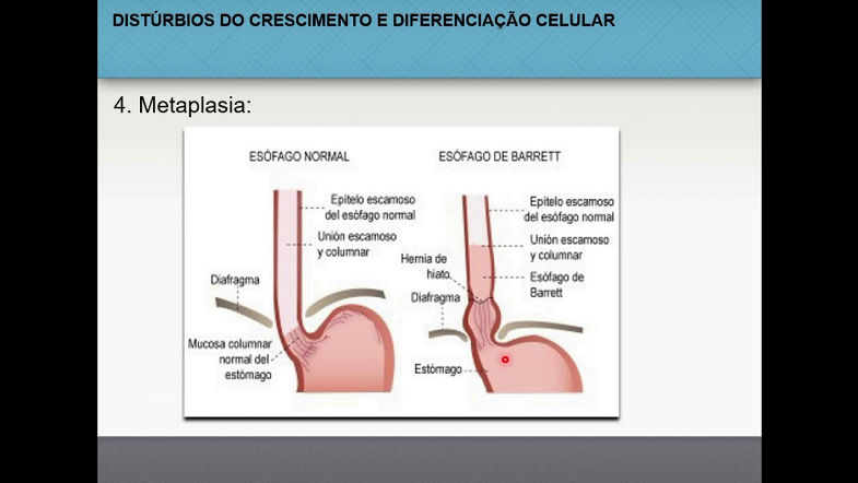 Distúrbios do crescimento e diferenciação celulares - Patologia geral (46)