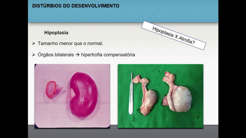 Distúrbios do crescimento e diferenciação celulares - Patologia geral (66)