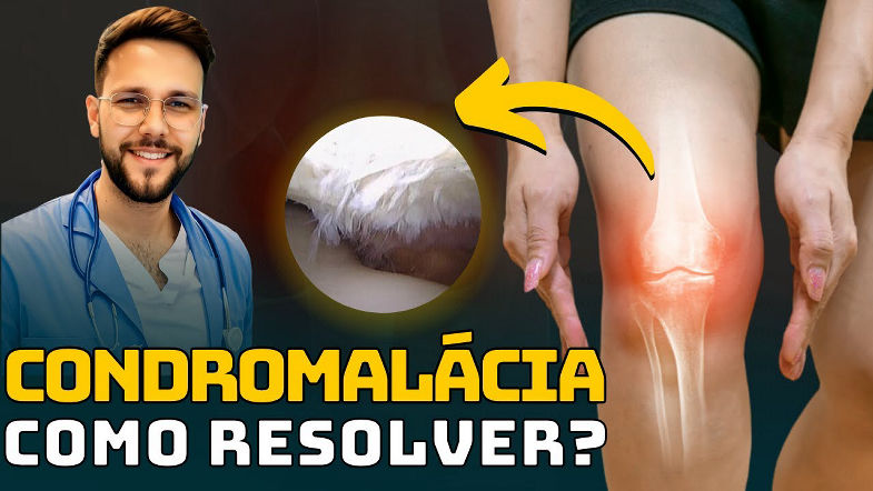 COMO CURAR A CONDROMALÁCIA PATELAR? Exercícios para alívio da dor no joelho