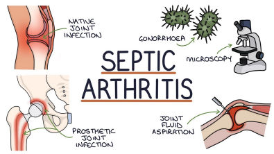 Understanding Septic Arthritis