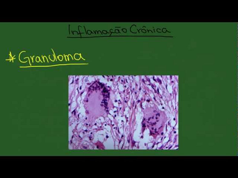 Inflamação Crônica - Resumo - Patologia Geral