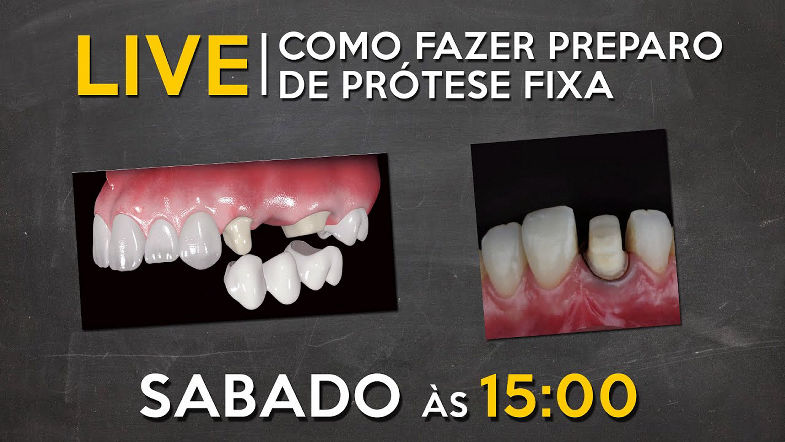 LIVE 060 - Como fazer preparo de prótese fixa