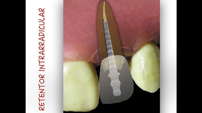 Retentores intrarradiculares - parte 02