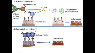 Hipersensibilidades (4/5): Tipo IV - mediada por linfócitos T