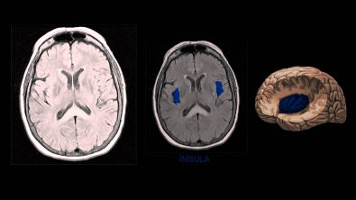 NEUROIMAGEM  - Anatomia Cerebral na Ressonância Magnética