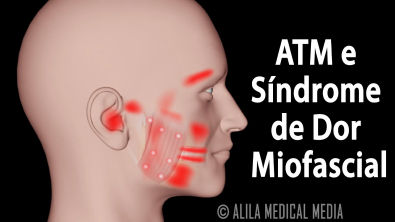 ATM e Síndrome de Dor Miofascial, Animação. Alila Medical Media Português.