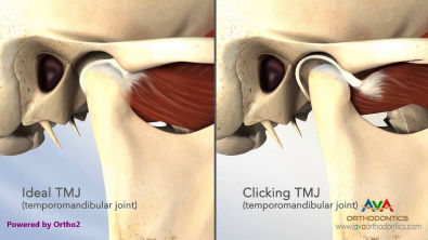TMJ Disease (AKA TMD): Clicking and Closed Lock