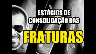 Vídeo Aula 127 - Osteologia - Fraturas: Estágios de Consolidação - Sistema Ósseo/Esquelético