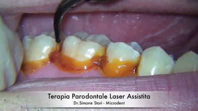 Atendimentos de Terapia Parodontale Laser Assistita