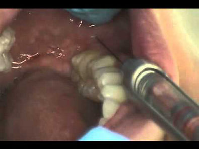 Long_Buccal_Injection.flv