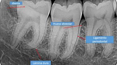 Aspecto radiografico de las lesiones del periodonto   YouTube (360p)