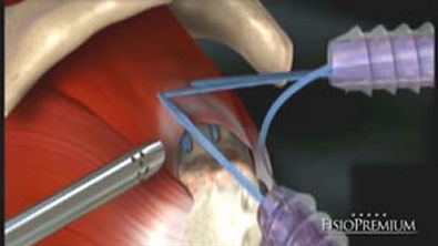 Anatomia de Ombro, Ruptura de Manguito Rotador e Cirurgia de Reconstrução de Manguito Rotador