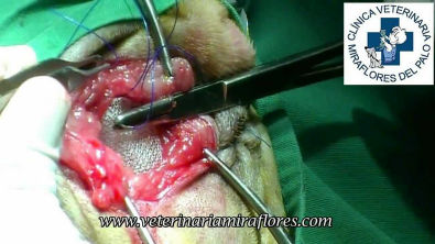 Hernia perineal usando malla de polipropileno. Cirugía Miraflores del Palo
