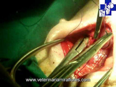 Hernia inguinal bilateral congénita.Cirugía Miraflores del Palo