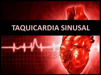 Arritmias cardíacas - Taquicardia sinusal