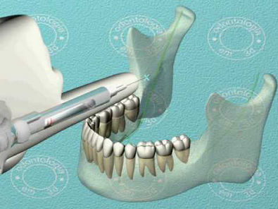 Dentista 3d Anestesia Pterigomandibular