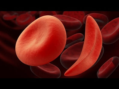 O que é anemia falciforme?