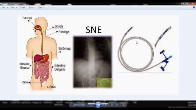 SNE, SNG, Gastrostomia e Jejunostomia (Básico)