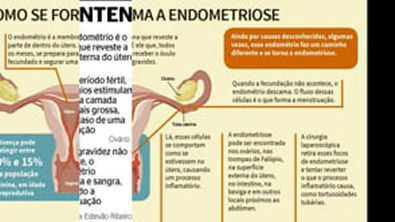 Endometriose - Fatores genéticos, endócrinos, imunológicos e ambientais tem sido sugeridos em sua patogênese.