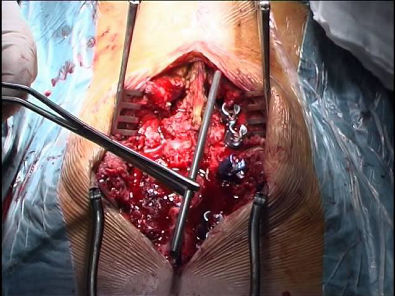 Cirugia columna fractura luxacion vertebral