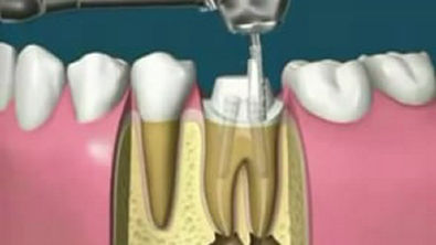 endodontia video