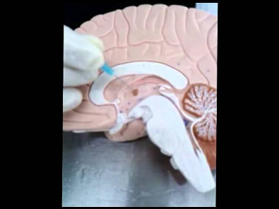 Vídeo-Aula Neuroanatomia (Telencéfalo, Diencéfalo, Tronco Encefálico, Meninges, Ventrículos)