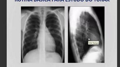 Vídeo Aula 002 - Anatomia Radiológica do Tórax [Radiologia na Palma da Mão]