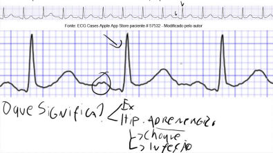 Descomplicando o ECG - Aula 10 - Arritmia sinusal, taquicardia sinusal, bradicardia sinusal