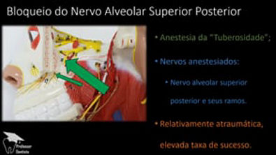 Anestesia da Tuberosidade - Bloqueio do Nervo Alveolar Superior Posterior - YouTube (360p)