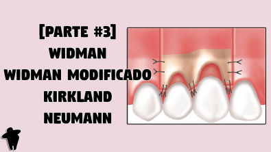 Aula de Periodontia - Retalhos Periodontais de Widman, Widman Modificado, Kirkland e Neumann