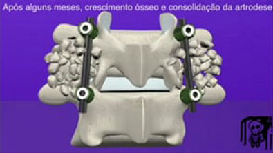 Cirurgia de Coluna Artrodese Lombar