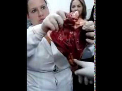 Coração sendo dissecado-Curso de enfermagem-Aula de anatomia