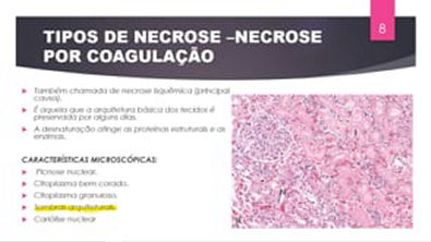 Lesão irreversível - NECROSE (PARTE II)