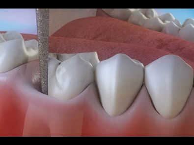 Endodontia Tratamento endodôntico para cárie dentaria ©