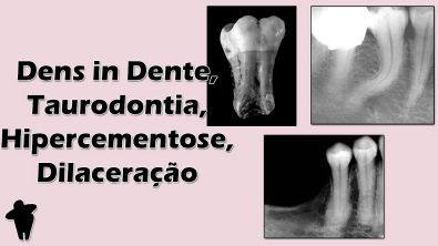 Alterações de Desenvolvimento [PT 2] - Dens In Dente, Taurodontia, Hipercementose - Patologia Bucal