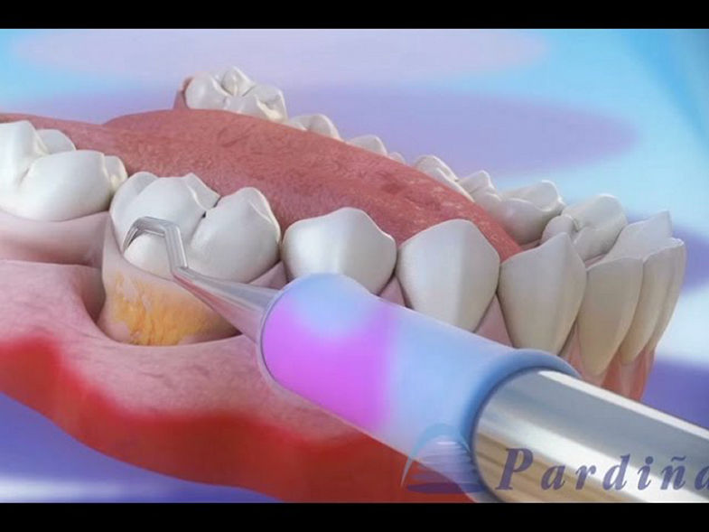 O tratamento da periodontite - Raspagem e alisamento ©